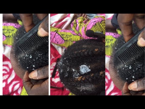 Asmr Cleaning dandruff for sleep | Asmr Video| #asmr #dandruff #oddlysatisfying