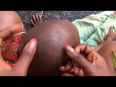 Nitpicking Whiteheads And Blackheads On The Scalp 😳🤯  #satisfying #nitpicking #oddlysatisfying