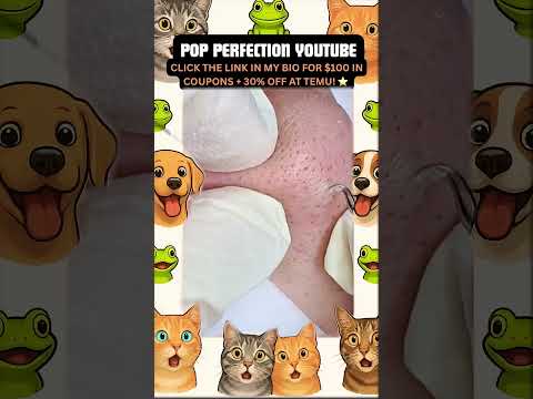 Wow! #pimpleremoval #pimple #pimples #shortsfeed #shortvideo #shorts #short #youtube #youtubeshorts