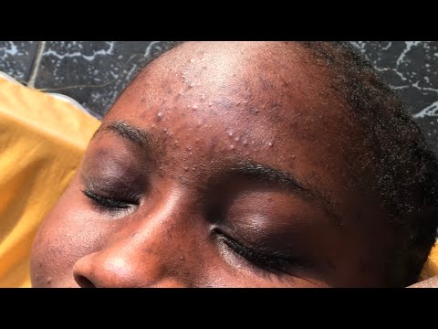 Full face Nitpicking For Those who want To Sleep #asmr #satisfying