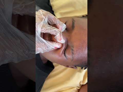 Asmr whiteheads nitpicking video for relaxation #tingling #asmr