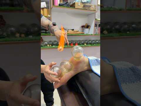 Her legs burned 😱#asmr #shorts #explore #massage #viral #cupping #youtubeshorts #fire