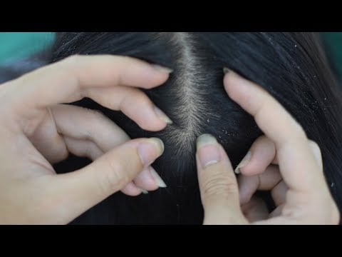ASMR Scalp Scratching Aggressive, Scalp Massage Tingles For Headache Relief ( No Talking )