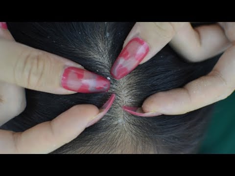 ASMR Scalp Scratching, Head Scratching Sounds For Relieve Stress, Headache, Anxiety ( No Talking )