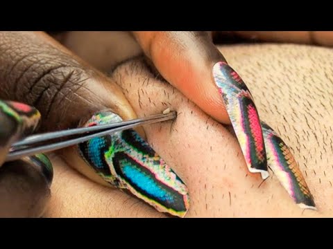 ASMR Upclose Picking Whiteheads On face for sleep 😴 | allzoomed ~ soft whispers