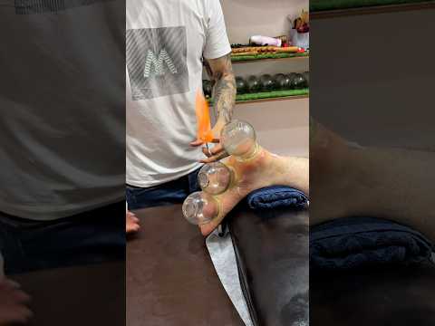 Have you ever experienced it?#shortsviral #shorts #explore #cupping #fyp #asmr
