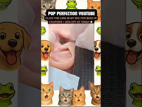 Wow! #pimpleremoval #pimple #pimples #shortsfeed #shortvideo #shorts #short #youtube #youtubeshorts