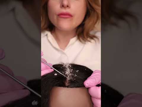 ASMR Dandruff Removal