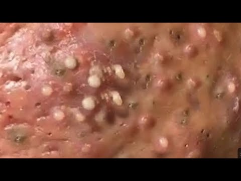 SATISFYING AND RELAXING PIMPLE POP COMPILATION | PART 24