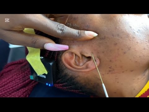 ASMR SATISFYING DEEP EAR NITPICKING CLEANING MASSAGE AND SCALP SCRATCH, Back Scratching