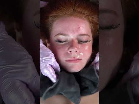 Watch This Satisfying Facial Cleanse Transformation! #shorts