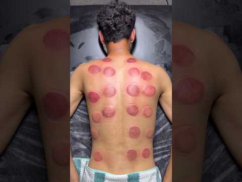 ASMR cupping😍❤️#asmr #youtubeshorts #trending #shorts #viral #relaxing #fyp #cupping #asmrsounds