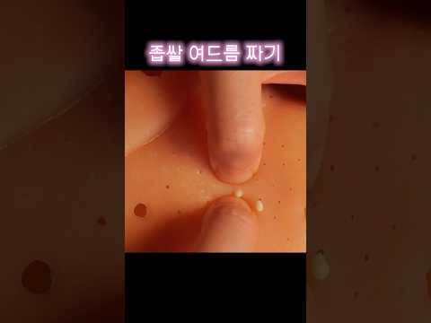좁쌀 여드름 폭주 기관차 ASMR