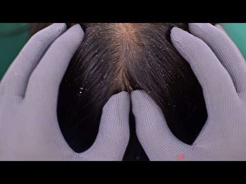 ASMR Dandruff Scratching, Scalp Scratching With Gloves Relaxing For Sleep ( No Talking )