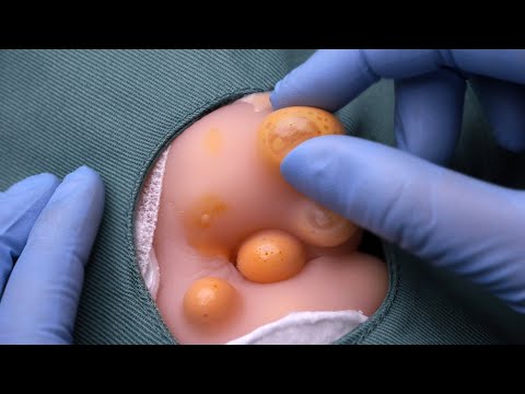 [ASMR] 厄介なおヘソ周辺のオペします👩‍⚕💉 (ニキビ治療ロールプレイ, 字幕)