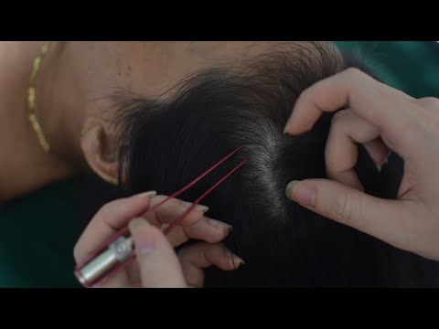 ASMR Real Person Scalp Massage, Scalp Scratching Aggressive, Sounds Make You Stress Relief