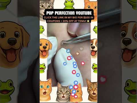 Wow! #pimpleremoval #pimple #pimples #shortsfeed #shortvideo #shorts #short #youtube #youtubeshorts