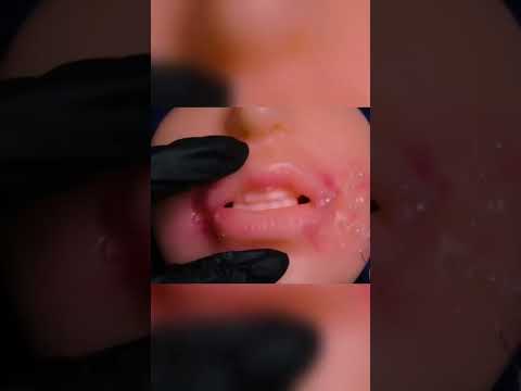 ASMR preview do vídeo de hoje! Tratando a sua herpes labial #shorts #fypシ #asmr