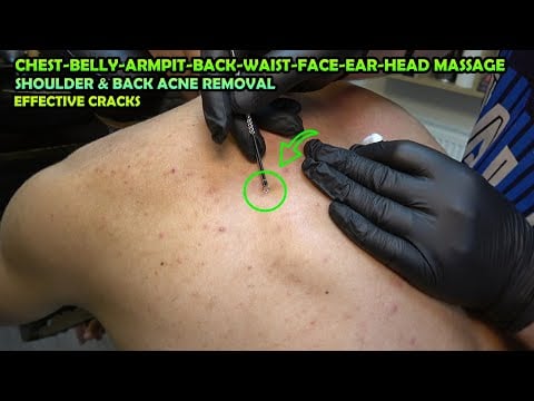 💈 DEEP SHOULDER & BACK ACNE REMOVAL - LOUD CRACKS - ASMR BARBER head,face,chest,belly,armpit massage