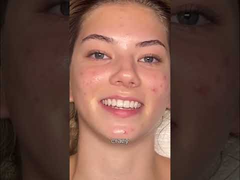 Clear Your Acne: The PCOS Skincare Secret Revealed! #shorts