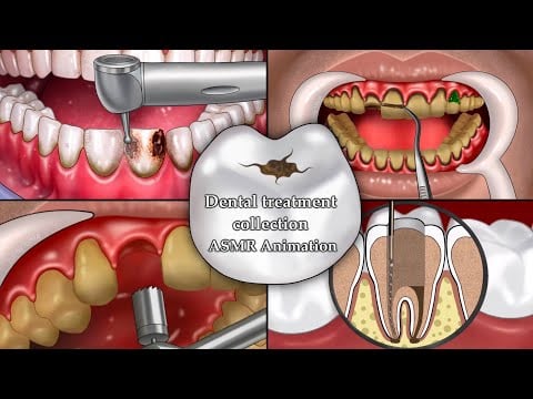 ASMR dental decay treatment animation collection, Relaxing tooth care ASMR animation, ASMR animation